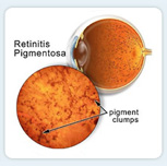 Retinitis pigmentosa (RP) is a rare, hereditary disease that causes the rod photoreceptors in the retina to gradually deteriorate.