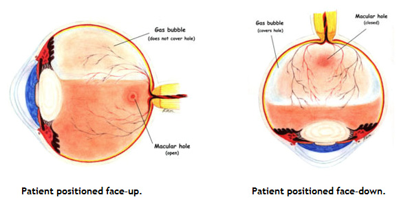 Because the macula is located in the back part of the eye, a patient's head must remain in a face–down orientation to allow the air bubble to rise toward the back of the eye and exert this pressure.