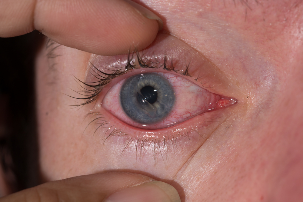 scratched cornea symptoms of a scratched cornea eye center of scratched cornea symptoms of a scratched cornea eye center of