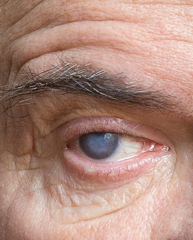 Laser Cataract Surgery vs. Traditional Cataract Surgery