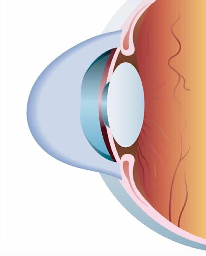 Keratoconus