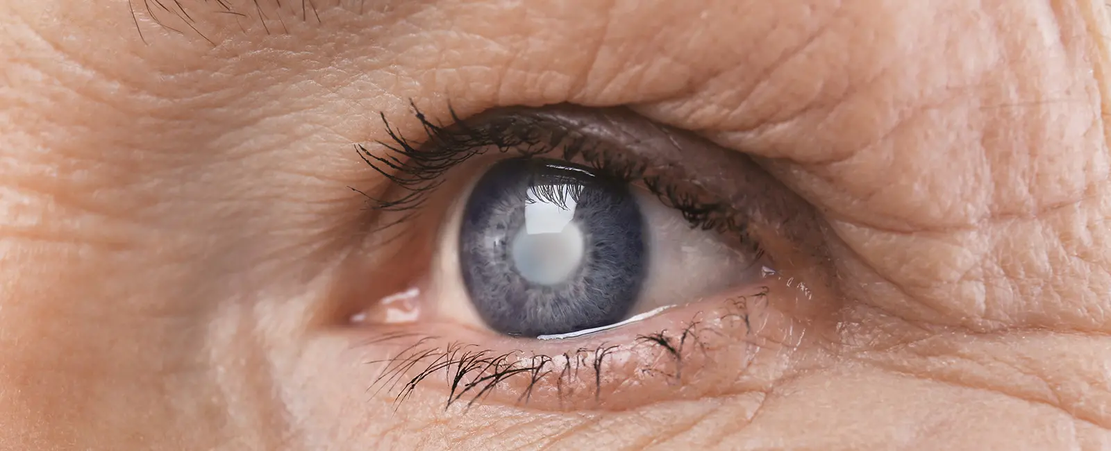 Choosing a Multifocal Lens for Cataract Surgery