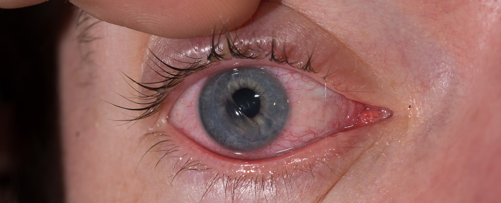 Symptoms of a Scratched Cornea