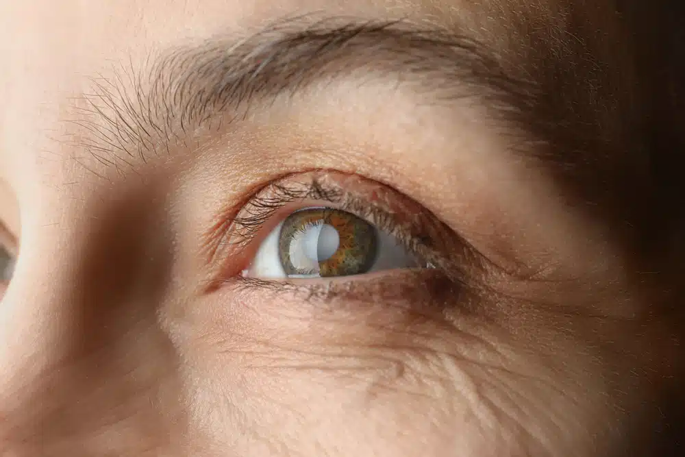 What Are the Most Common Problems After Cataract Surgery?