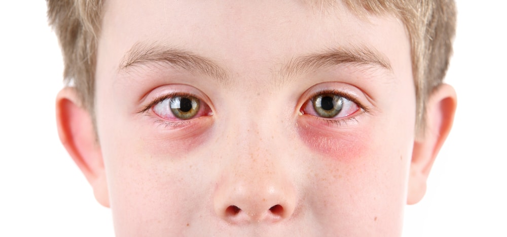 What Are the Signs of Pink Eye?