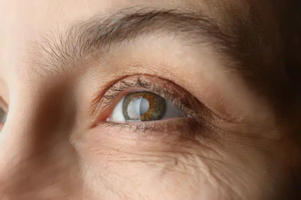 What is the Average Age for Cataract Surgery?