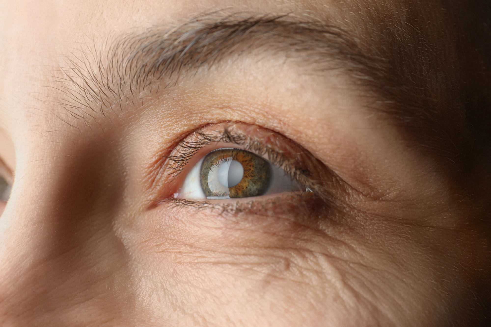 How Do You Know When to Have Cataract Surgery? 