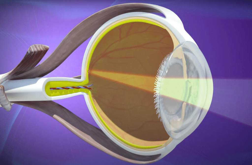 Your Cataract Surgery Lens Options Explained