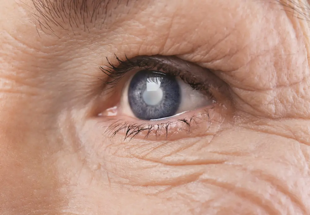 What To Do About Double Vision After Cataract Surgery