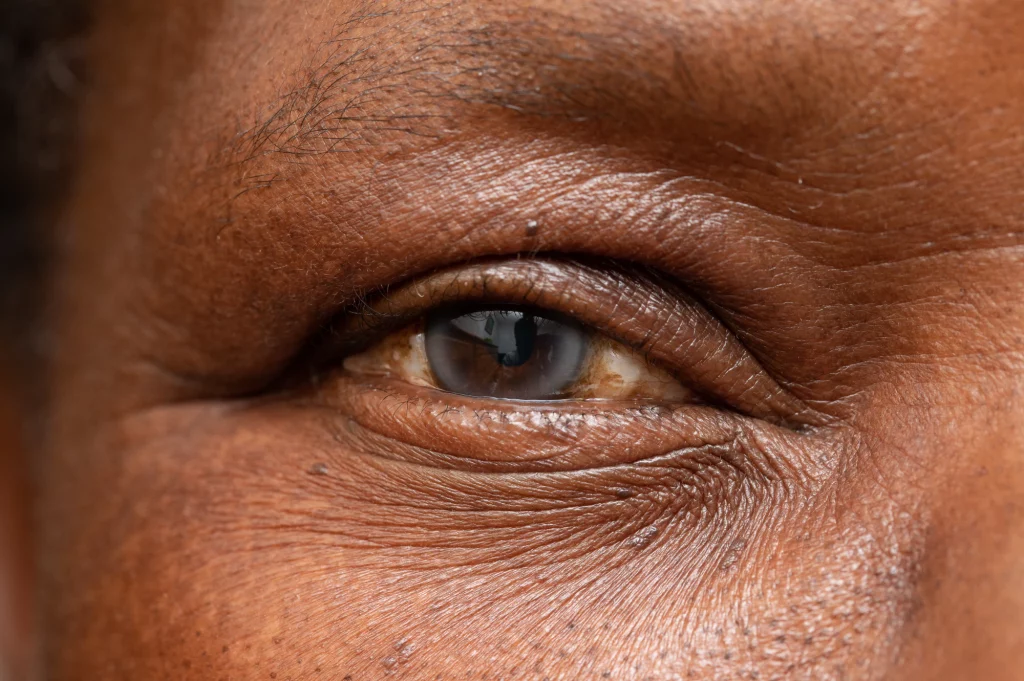 What Are the Three Types of Cataracts?
