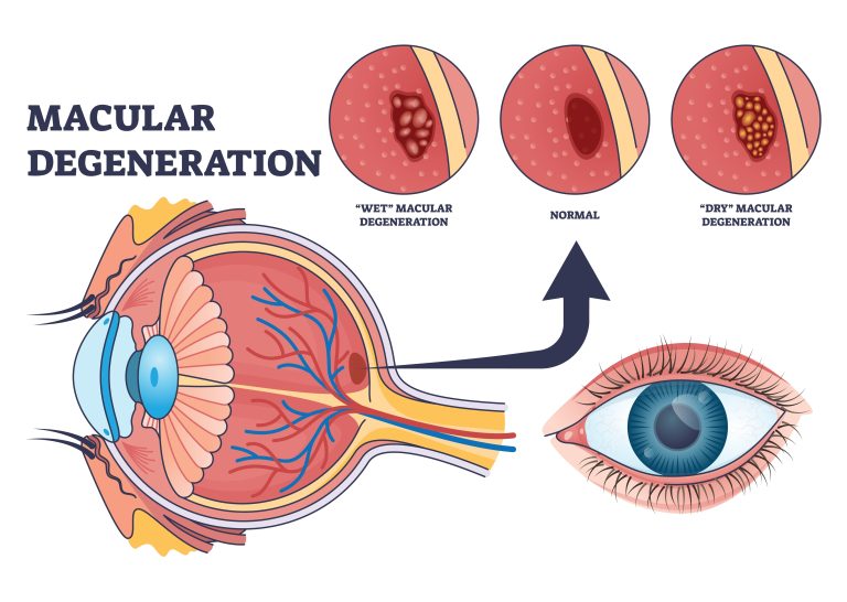 Can macular degeneration be cured eye center of texas