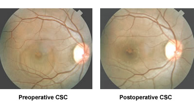 Preoperative CSC and Postoperative CSC