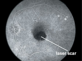 After treatment. This fluorescein angiogram shows the same eye after laser treatment. The CNV beneath the macula has been successfully treated.
