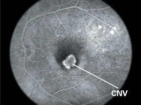 Before treatment. This fluorescein angiogram shows a well–defined area of choroidal neovascularization (CNV) underneath the macula.
