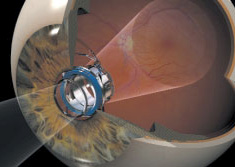 With the IMT, central vision is projected on the central and peripheral retina.