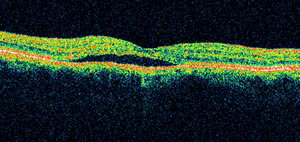 Clinical photo of a patient with central serous chorioretinopathy (CSC).