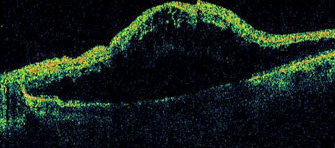 Optical Coherence Tomography showing macular edema from a central vein occlusion.