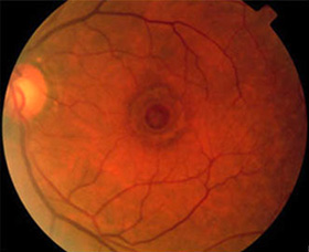 Clinical Photo of a Macular Hole