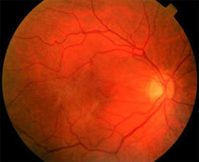 231682 Clinical Macular Pucker 231682 Clinical Macular Pucker