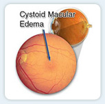 Cystoid macular edema (CME), or swelling of the macula, can occur as a result of disease, injury, or, occasionally, eye surgery.