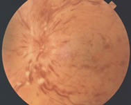 This is a color photograph showing diffuse intraretinal hemorrhage of a central retinal vein occlusion.