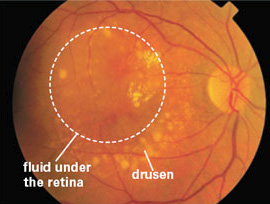 This retinal photograph shows many drusen and fluid under the retina, suggestive of choroidal neovascularization.