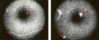 Early-phase fluorescein angiogram showing two small leaks (arrows). Fluorescein dye progressively leaks beneath the retina causing central visual distortion and blurriness.