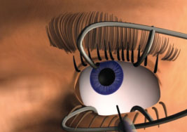 After preparation, the eyelids are pulled back and Macugen is injected into the vitreous body of the eye.