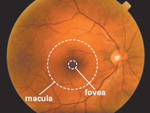 This photograph shows a normal, healthy retina as viewed by an eye doctor during an examination.