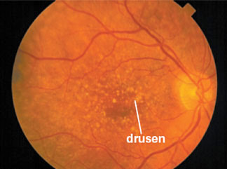This retinal photograph shows numerous yellow drusen in and around the macular region of the retina.