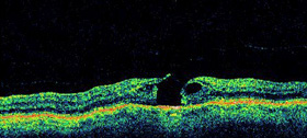 OCT of a Macular Hole