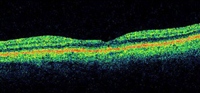 Optical Coherence Tomography (OCT) after surgical repair of a macular hole.