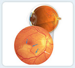 A retinal artery occlusion occurs when the central retinal artery or one of the arteries that branch off of it becomes blocked.