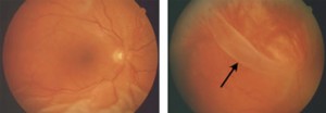 231746-retinal-detachment-diagnoses