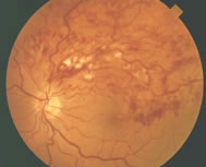 Color photograph showing segmental intraretinal hemorrhage of a branch retinal vein occlusion.