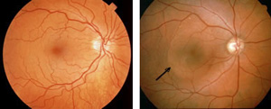 Normal macula demonstrating a serous neurosensory detachment (red arrow).