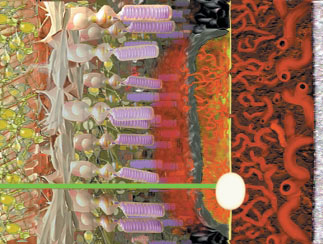 The laser light (shown in green) passes through the tissues of the retina. In the area of CNV, the laser energy is converted into heat (white spot). This heat burns the CNV and some of the surrounding retinal tissues.
