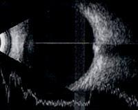 ultrasound(b-scan)
